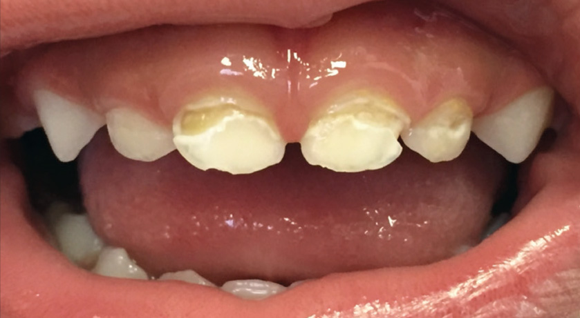 young kid gets help at floss boss for Active-cavitated-caries-lesions