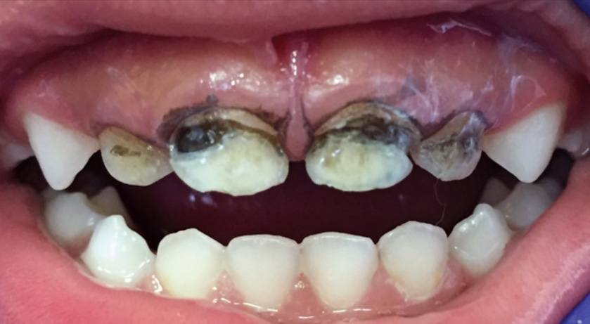 lesions-with-temporary-gingival-staining-young kid received help at floss boss
